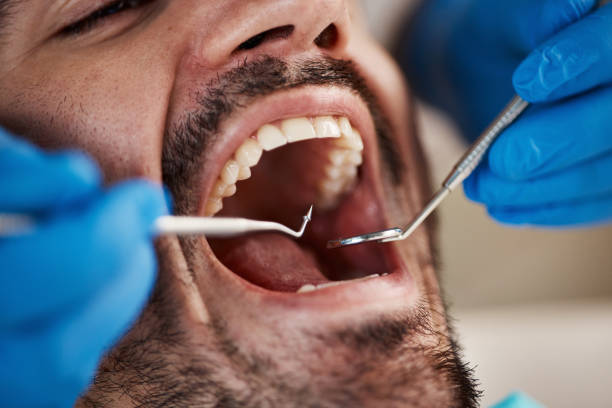 Best Emergency Wisdom Teeth Removal in Deep River Center, CT